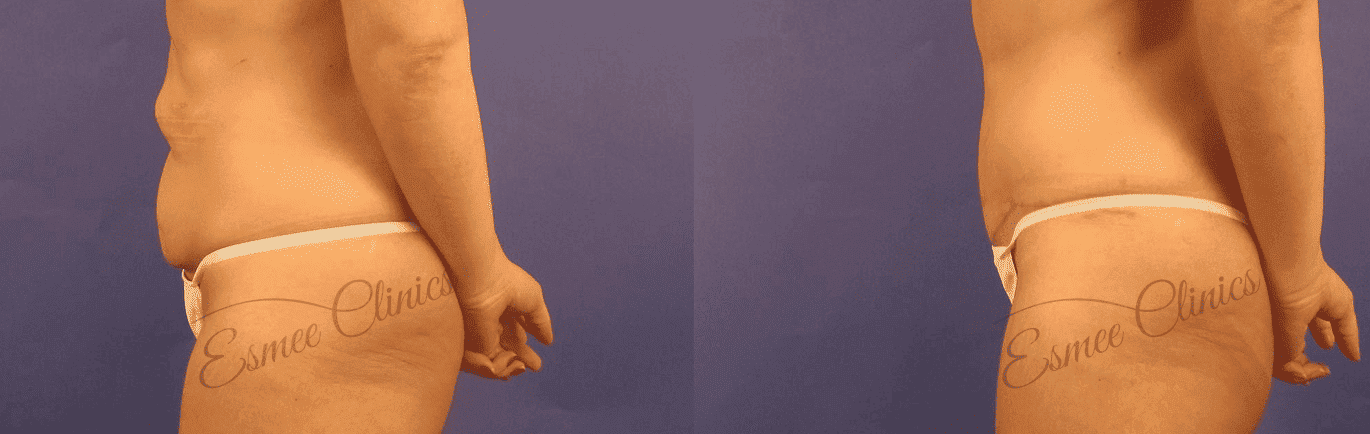 Before and After img